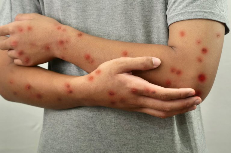 Variole du singe: Le Ministère de la santé prend la parole
